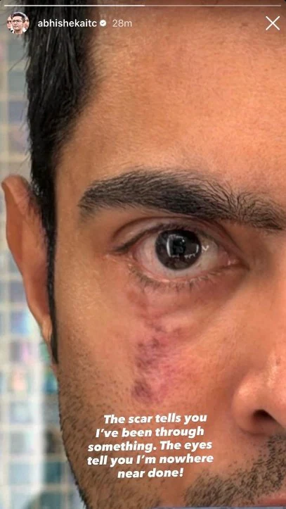 Trinamool MP Abhishek Banerjee wants you to see his scarred confronts