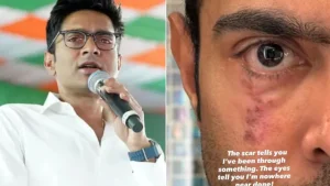 Trinamool MP Abhishek Banerjee wants you to see his scarred confronts