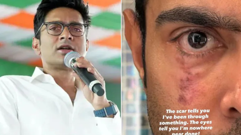 Trinamool MP Abhishek Banerjee wants you to see his scarred confronts