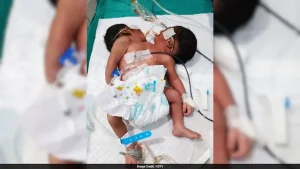 Dicephalic parapagus is a rare form of conjoined twinning in which two heads share a single body