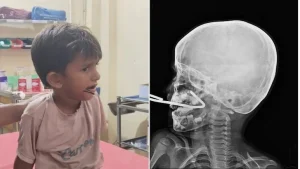 Iron Rod Pierces Gujarat Boy's Mouth As He Falls While Playing